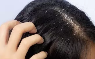 Dandruff 