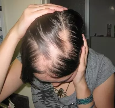 hair loss due to thyroid